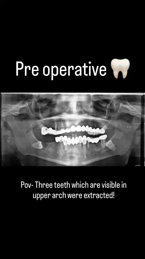 Basal implant placement clinical case